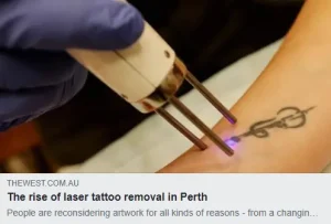 Close-up of a gloved hand holding a handheld laser device that emits a purple beam onto a dark forearm tattoo, illustrating a laser tattoo removal procedure